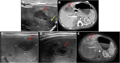 Point-of-care ultrasound in early diagnosis and monitoring of deep abscess in newborns: a case report of two cases